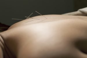 L'acupuncture est-elle vraiment efficace pour arrêter de fumer ?